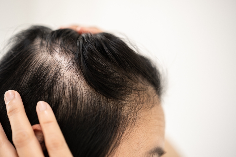 How to Regrow Hair On Bald Spot Este